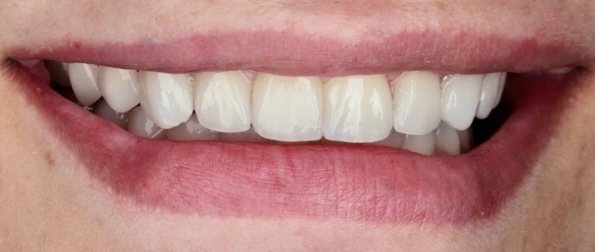 Full Smile Transformation & Bespoke Veneers - Finished Result